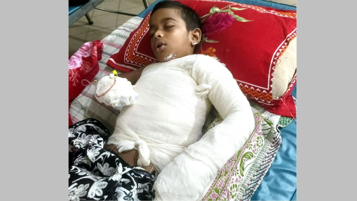 গ্যাস লাইটারের আগুনে দগ্ধ শিশু হাসপাতালে চিকিৎসাধীন